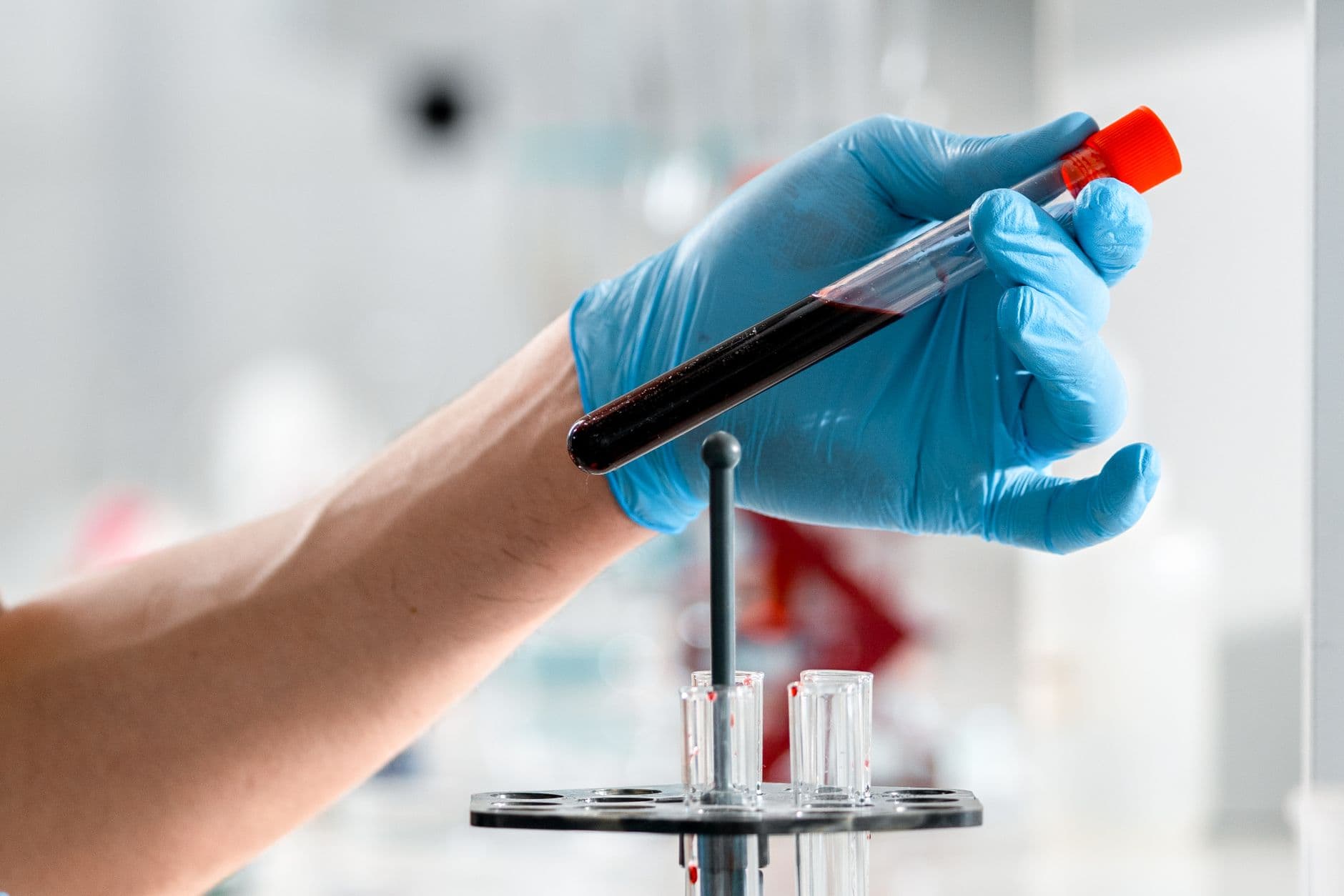 Tes Darah Baru Ungkap Risiko Demensia: Harapan Baru Deteksi Dini Alzheimer!
